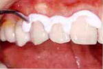 倉敷　予防歯科　PMTC2